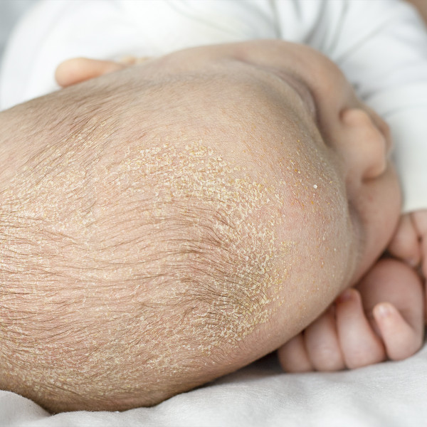 Crosta Láctea em Bebés: O que é e como cuidar da pele do seu filho